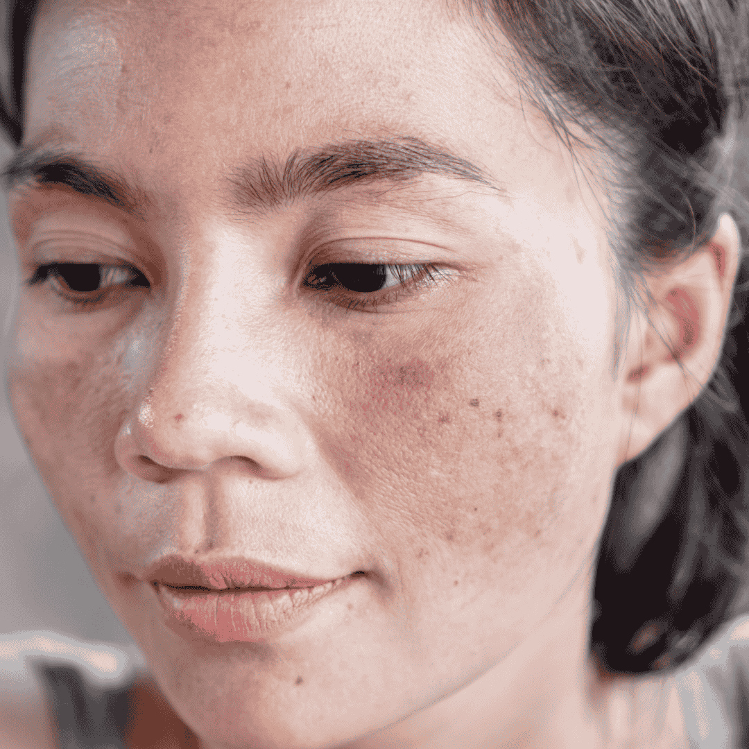 Pigmentation