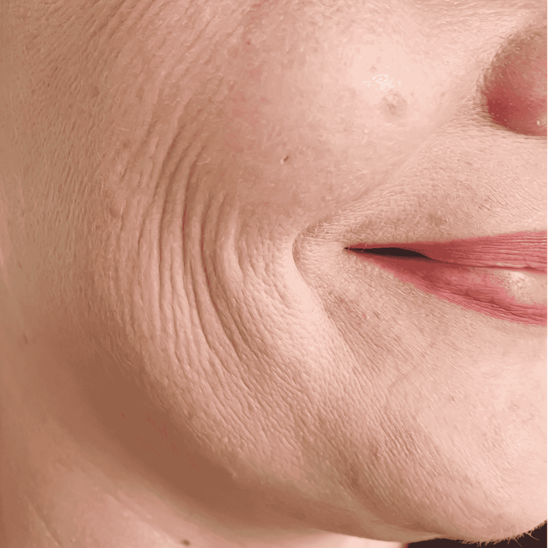 Aging & Wrinkles
