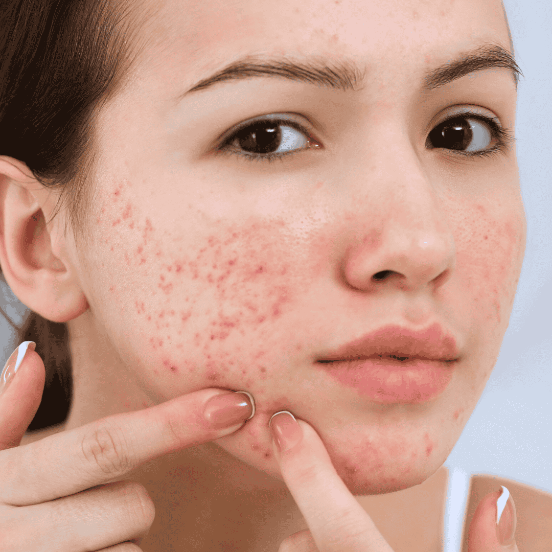 Acne & Pimples