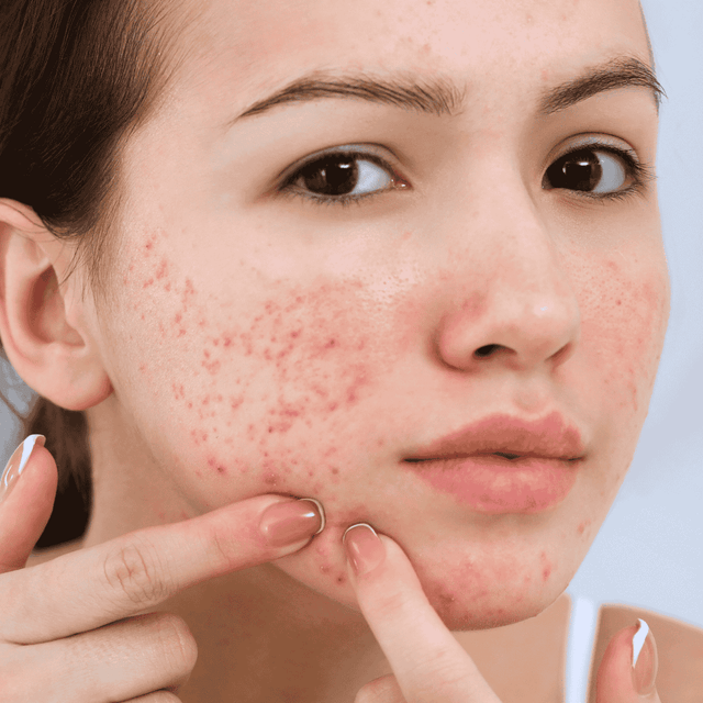 Acne & Pimples