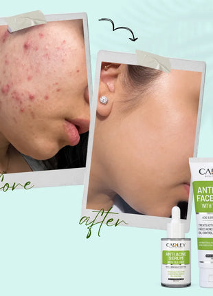Anti Acne Duo