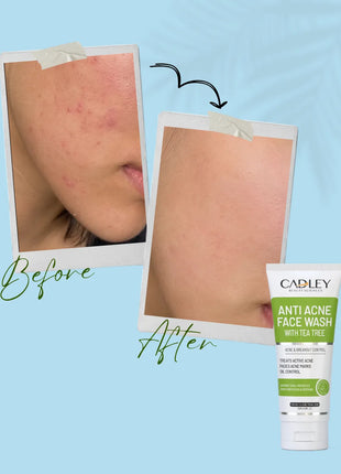 Anti Acne Face Wash with Tea Tree