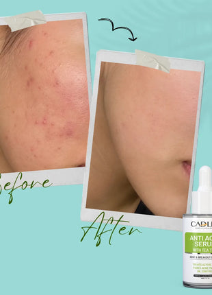 Anti Acne Serum with Tea Tree