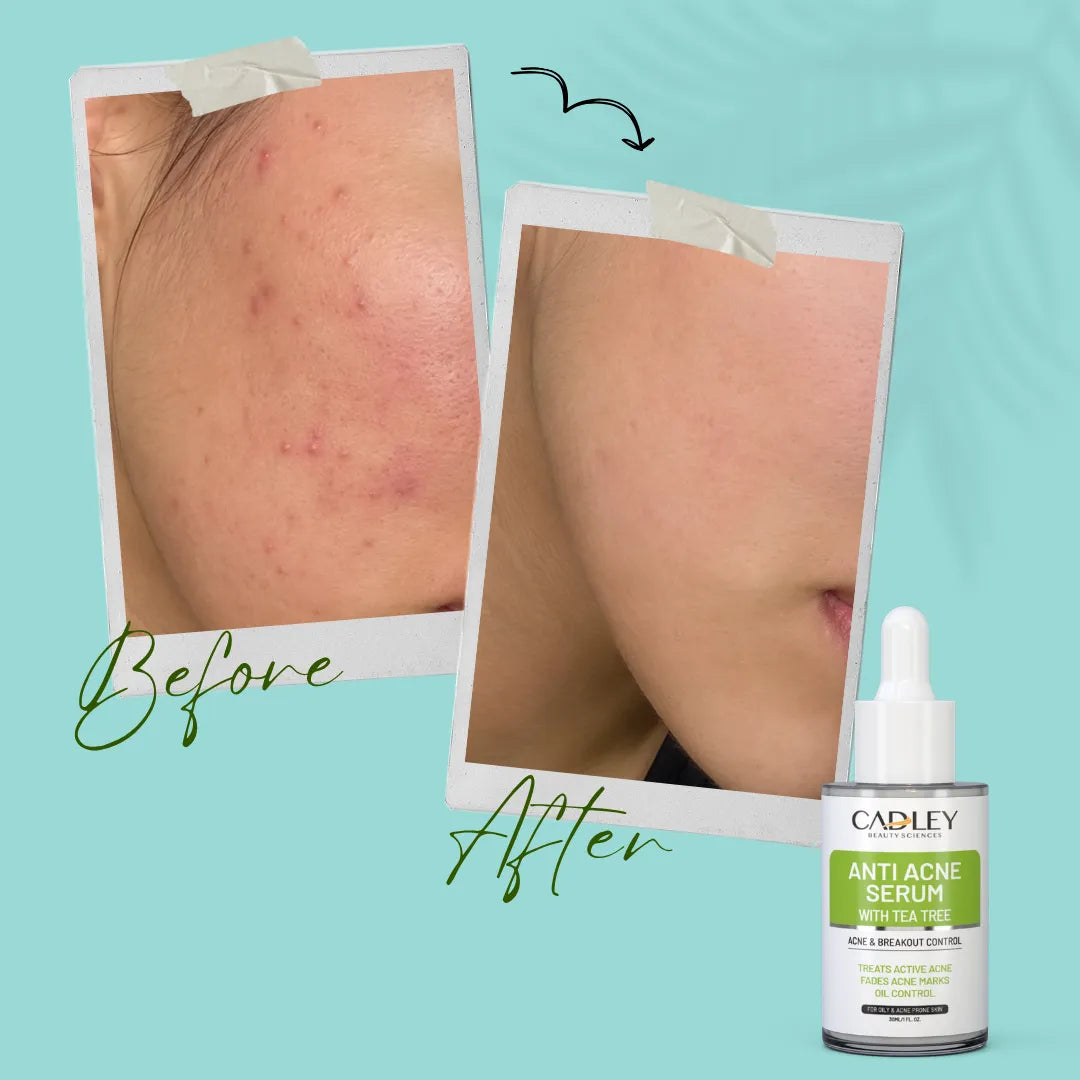 Anti Acne Serum with Tea Tree