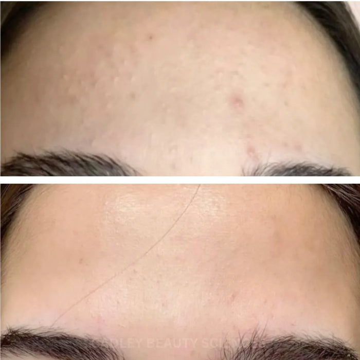 Madiha · 2 weeks forehead acne cleared